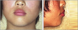 叢生 矯正治療前