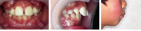 子供の出っ歯（でっぱ・上顎前突）の写真１