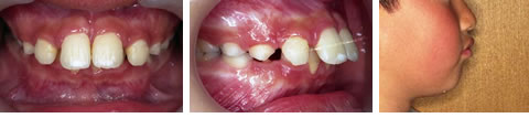 子供の出っ歯（でっ歯・上顎前突）の写真２