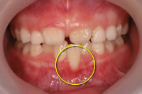 叢生により歯周組織に悪影響がでている状態