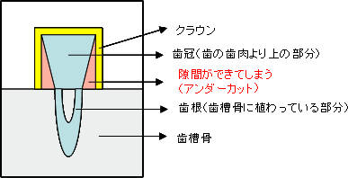 アンダーカット