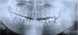 第２大臼歯と第３大臼歯がほとんど歯槽骨の中に埋まっている状態