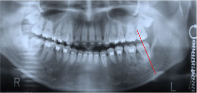 第２大臼歯の歯軸を整える