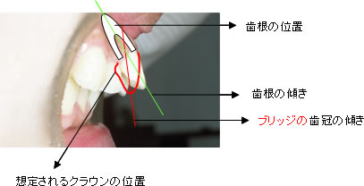 ブリッジで治療した時の想定図