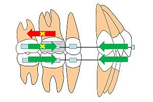 唇側矯正装置とヘッドギアを併用し、上顎大臼歯の前方移動を防止する際のイメージ