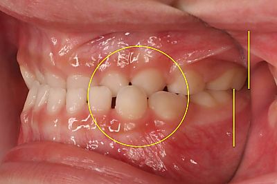 骨格的下顎前突症の乳犬歯、第二乳臼歯