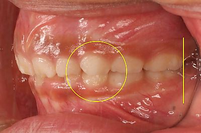 正常な乳犬歯、第二乳臼歯