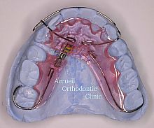 床矯正装置３（空隙閉鎖に用いる矯正装置） | アクイユ矯正歯科 