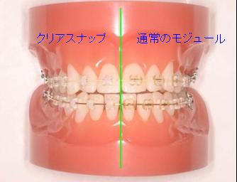 矯正装置｜埼玉県所沢市　歯列矯正