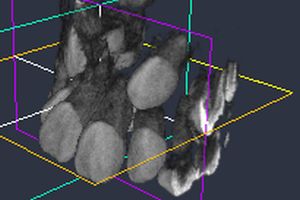 埋伏犬歯　CT画像