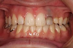 前歯が相対的に大きく見える１治療後