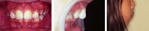 子供の出っ歯（でっぱ・上顎前突）の写真３