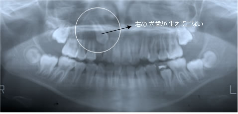 右の犬歯が生えてこない