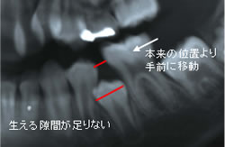 第一大臼歯が隙間を埋めようと手前に移動してしまったケース