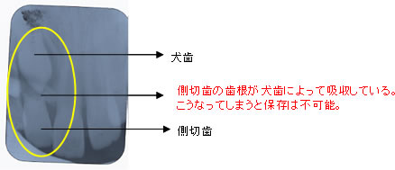 永久歯が永久歯の歯根を吸収してしまったケース