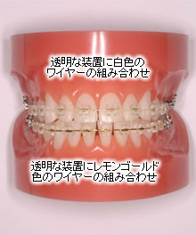 透明な装置(ブラケット)と白色のワイヤー