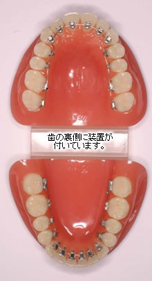 表から見えない装置(リンガルブラケット)
