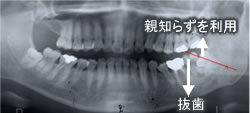 親知らずを利用