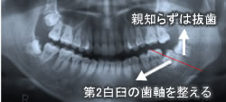 親知らずを抜歯