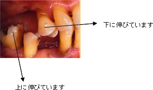 歯の無いところに歯は動く