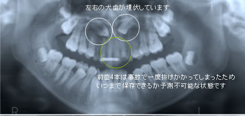 埋もれている歯を利用しよう