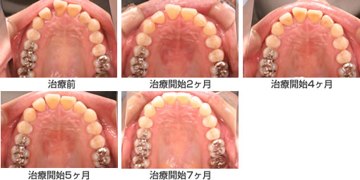 空隙歯列｜クリアアライナー｜所沢