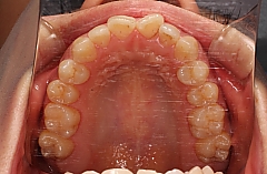 インビザラインの治療経過の写真　初診時上顎