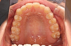 インビザラインの治療経過上顎　所沢市、入間市、狭山市近くのアクイユ矯正歯科