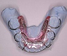 床矯正装置２（歯の後方移動に使用する矯正装置）｜アクイユ矯正歯科 
