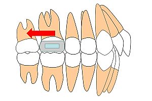 ヘッドギアで上顎大臼歯を後方移動する際のイメージ