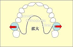 ポーター拡大アクチベート