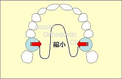 ポーター縮小アクチベート