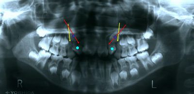 埋伏歯　パノラマレントゲン