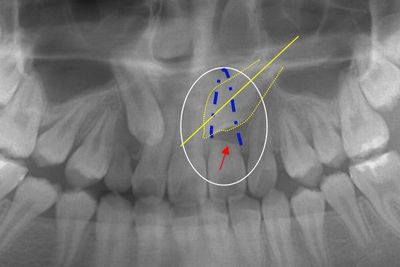 埋伏犬歯　側切歯歯根吸収　パノラマ