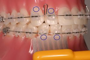 矯正治療中の歯ブラシの当て方