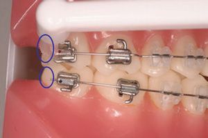 矯正治療中のワンタフトブラシの使い方