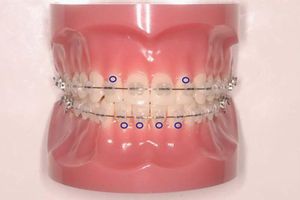 矯正治療中の虫歯の好発部位