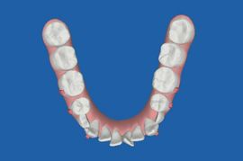 インビザライン治療開始後4か月目　クリンチェック　下顎咬合面