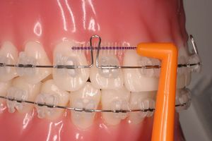 矯正治療中の歯間ブラシの使い方