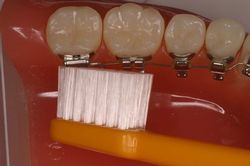 歯列矯正治療中の歯磨き１２｜埼玉県所沢市　アクイユ矯正歯科クリニック