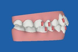 インビザラインの治療経過　クリンチェック　初診時　右側