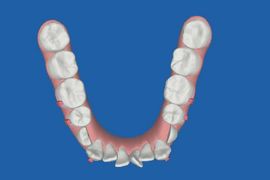 インビザラインの治療経過　クリンチェック　初診時　下顎咬合面