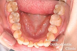 インビザラインの治療経過　初診時　下顎咬合面