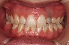 前歯が相対的に大きく見える１治療前