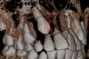 埋伏犬歯による歯根吸収