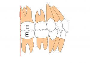 乳歯列正常咬合　ターミナルプレーン　垂直型