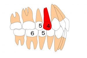 ４番抜歯
