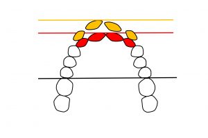 すっき歯による前歯部後退