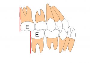 乳歯列　ターミナルプレーン　近心型　骨格性下顎前突症