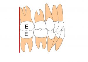 乳歯列　ターミナルプレーン　垂直型　歯性下顎前突症